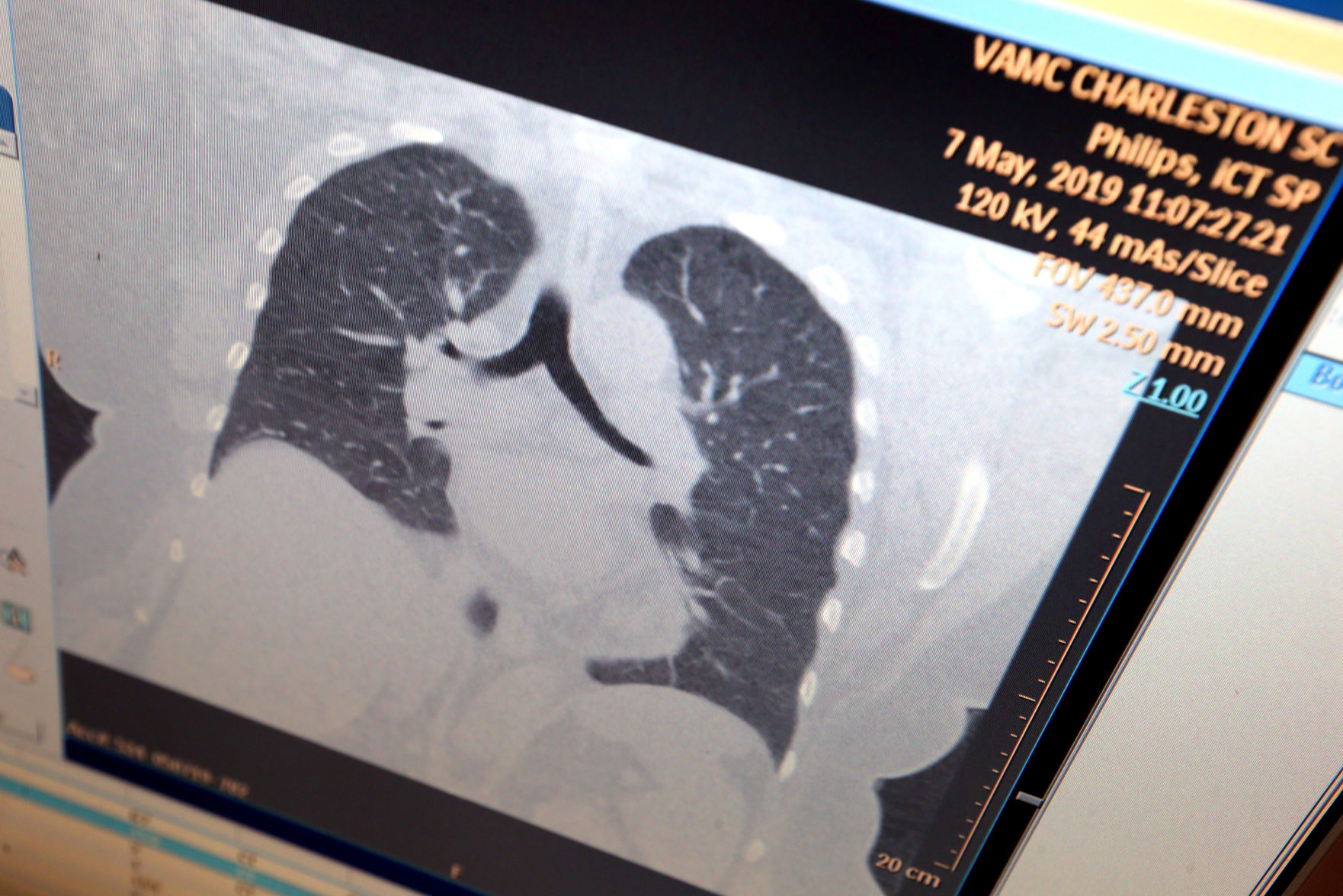 section lung cancer screening.jpg